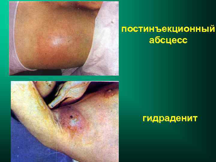 постинъекционный абсцесс гидраденит 