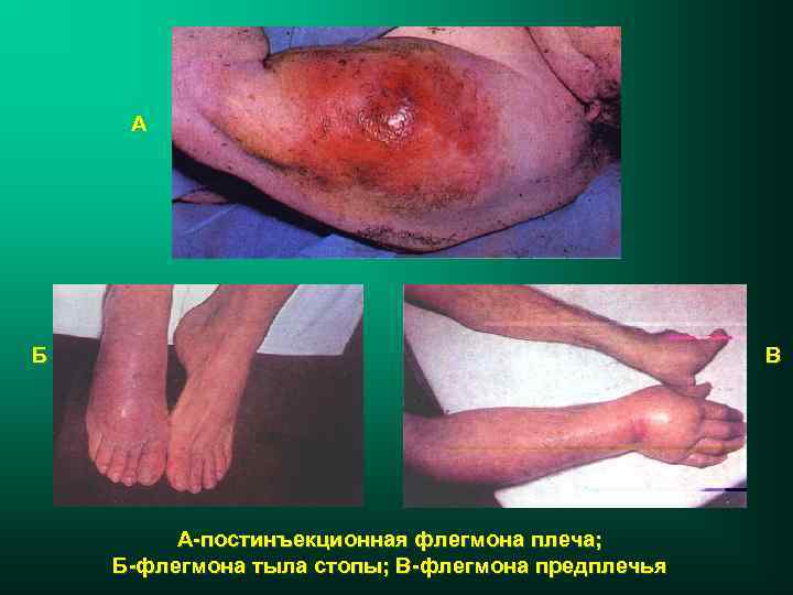 А Б В А-постинъекционная флегмона плеча; Б-флегмона тыла стопы; В-флегмона предплечья 