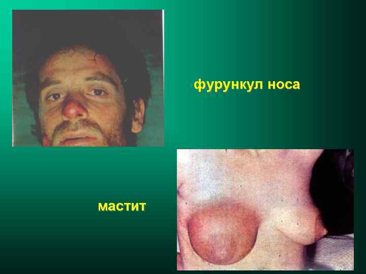 фурункул носа мастит 