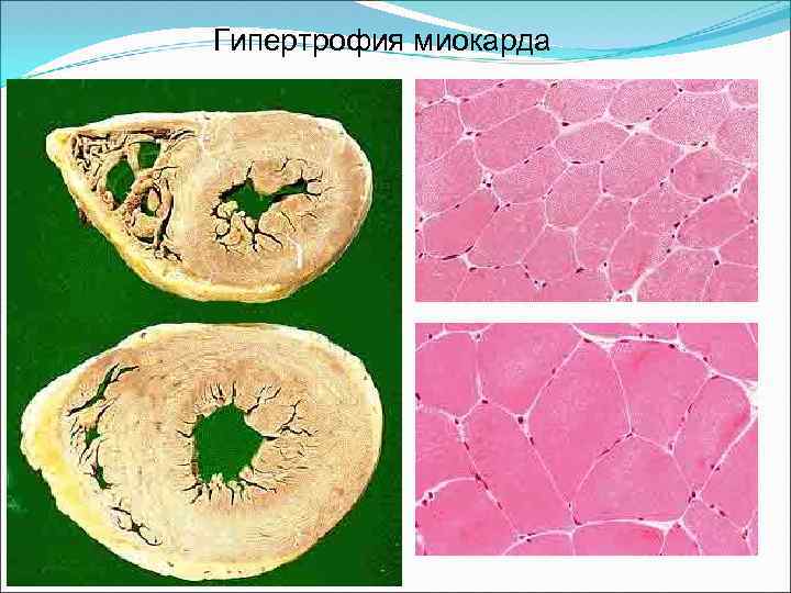 Гипертрофия миокарда рисунок