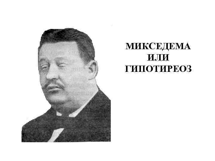 МИКСЕДЕМА ИЛИ ГИПОТИРЕОЗ 