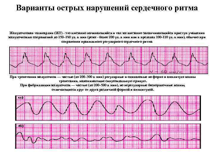 Варианты острых нарушений сердечного ритма Желудочковая тахикардия (ЖТ) - это внезапно начинающийся и так