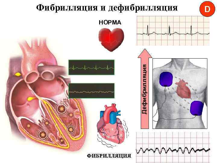 Фибрилляция и дефибрилляция Дефибрилляция НОРМА ФИБРИЛЛЯЦИЯ D 