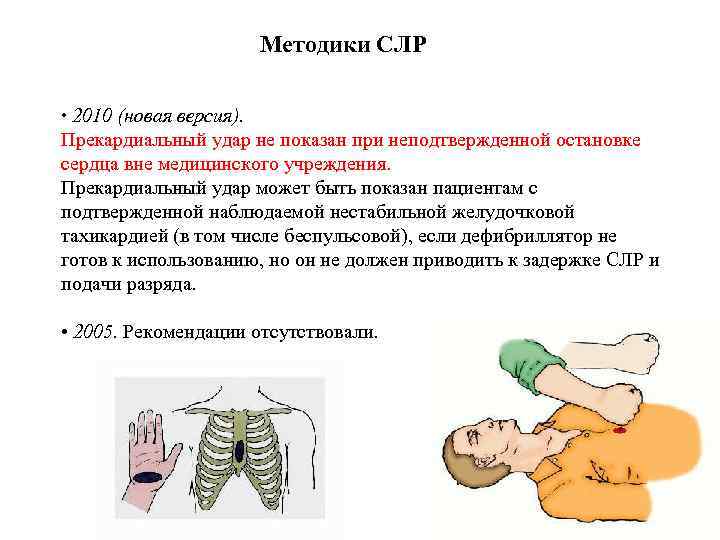 Методики СЛР • 2010 (новая версия). Прекардиальный удар не показан при неподтвержденной остановке сердца