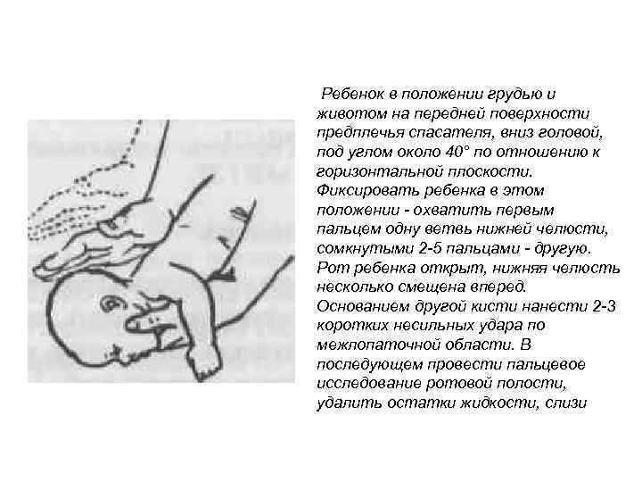 Ребенок в положении грудью и животом на передней поверхности предплечья спасателя, вниз головой, под