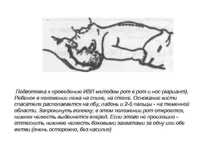 Подготовка к проведению ИВЛ методом рот в рот и нос (вариант). Ребенок в положении