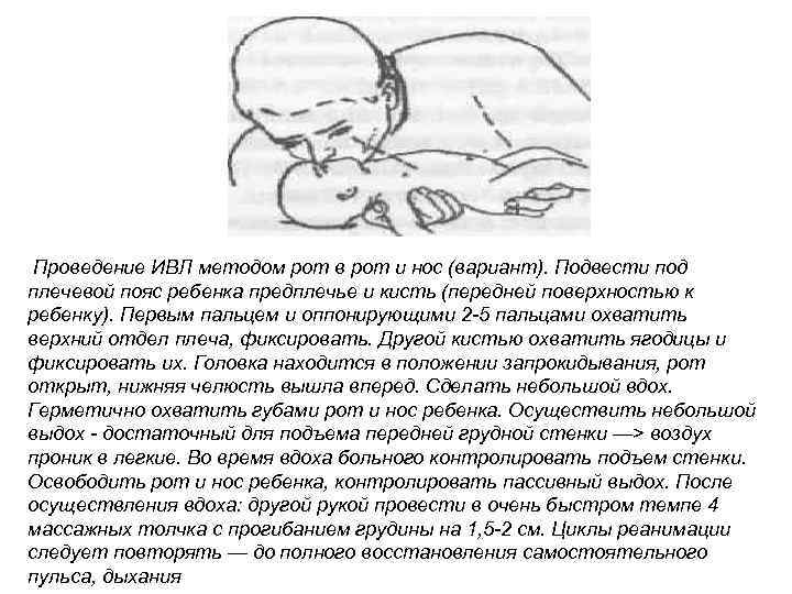 Проведение ИВЛ методом рот в рот и нос (вариант). Подвести под плечевой пояс ребенка