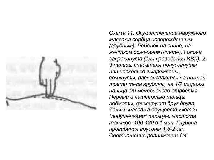 Схема 11. Осуществление наружного массажа сердца новорожденным (грудным). Ребенок на спине, на жестком основания