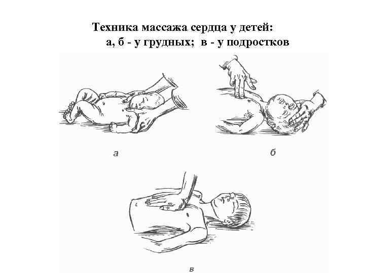 Техника массажа сердца у детей: а, б - у грудных; в - у подростков