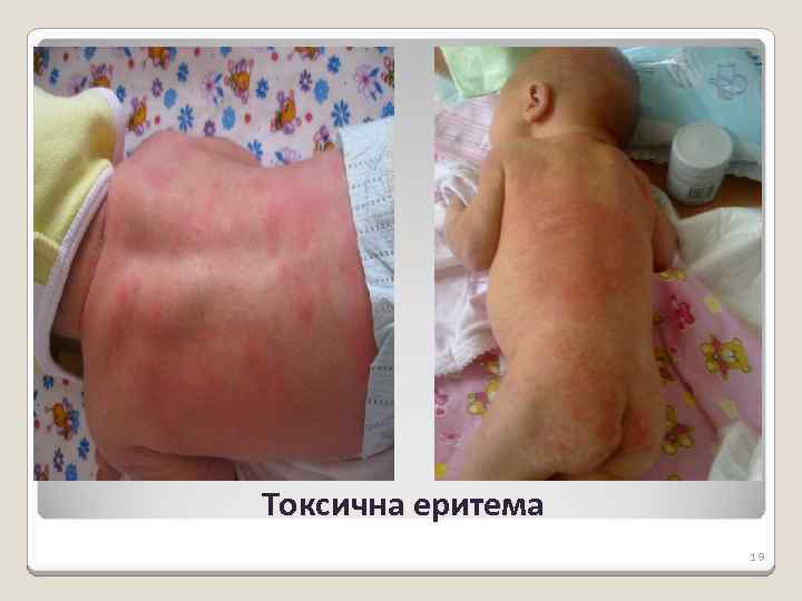 Токсична еритема 19 