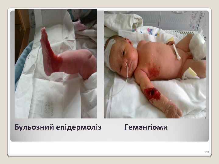Бульозний епідермоліз Гемангіоми 20 
