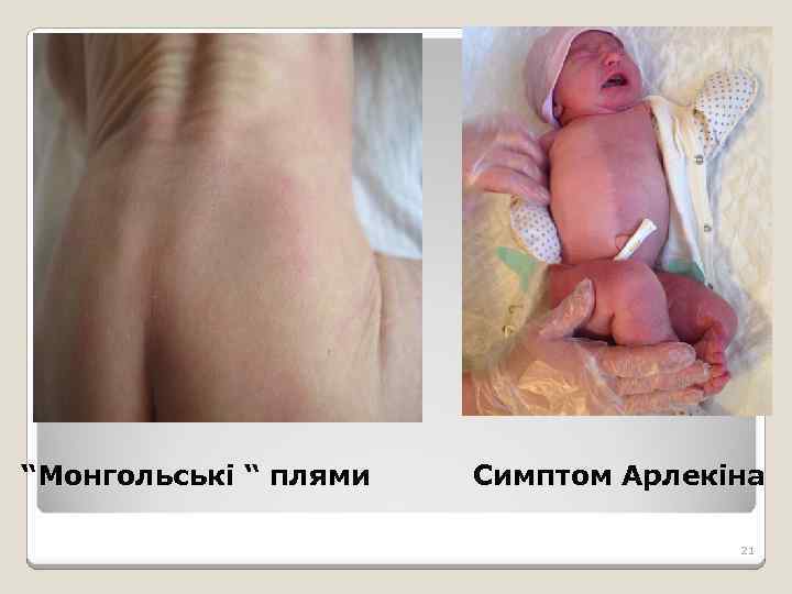 “Монгольські “ плями Симптом Арлекіна 21 