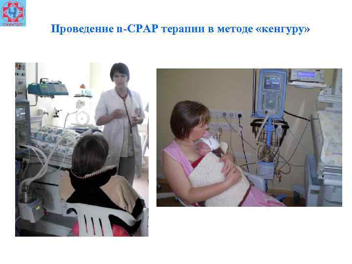 Проведение n-СРАР терапии в методе «кенгуру» 