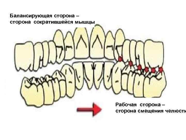 Боковая окклюзия. Рабочая и балансирующая сторона в ортопедии. Балансирующая окклюзия. Рабочая и балансирующая сторона стоматология. Односторонняя балансирующая окклюзия.