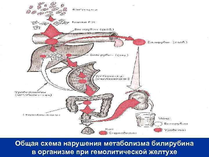 Схема гемолитической желтухи