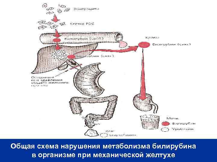 Патогенез механической желтухи схема