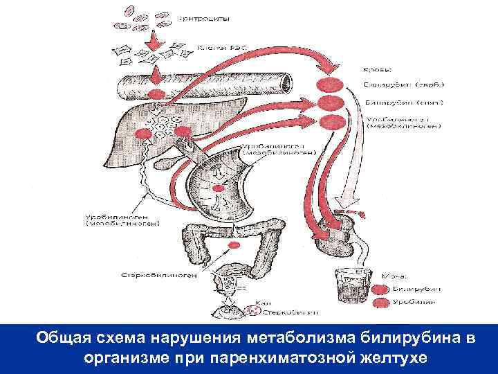 Паренхиматозная желтуха схема