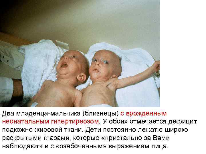 Два младенца-мальчика (близнецы) с врожденным неонатальным гипертиреозом. У обоих отмечается дефицит подкожно-жировой ткани. Дети