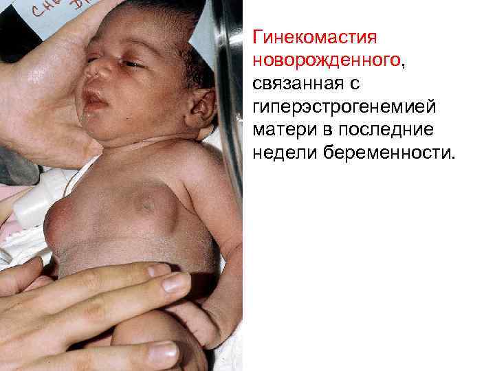 Гинекомастия новорожденного, связанная с гиперэстрогенемией матери в последние недели беременности. 