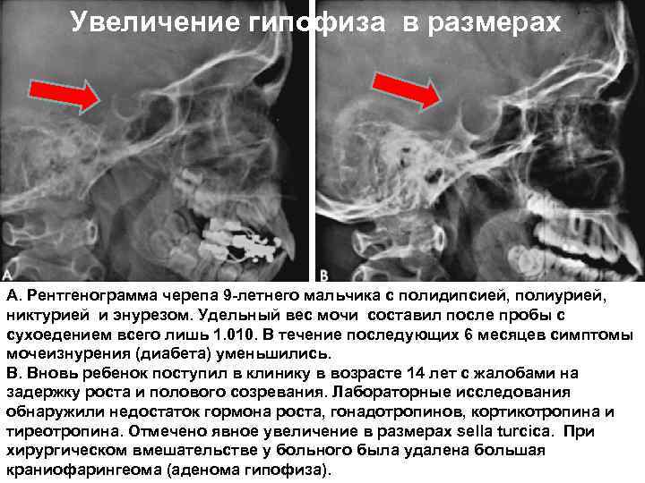 Увеличение гипофиза в размерах А. Рентгенограмма черепа 9 -летнего мальчика с полидипсией, полиурией, никтурией