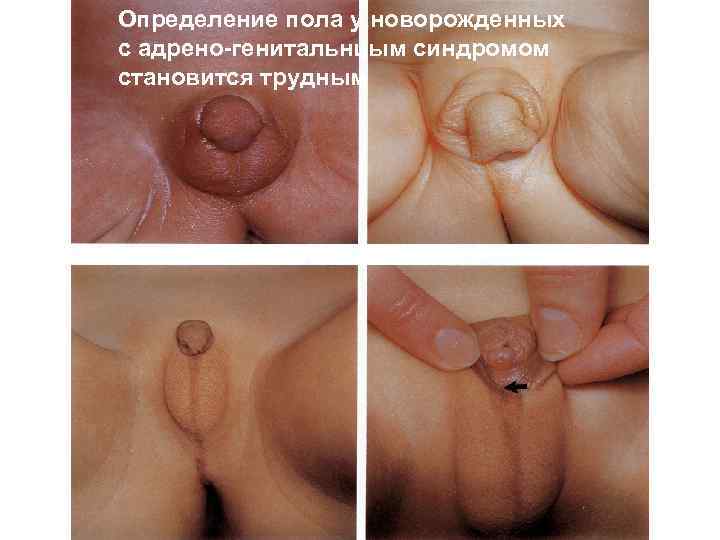 Определение пола у новорожденных с адрено-генитальнцым синдромом становится трудным 
