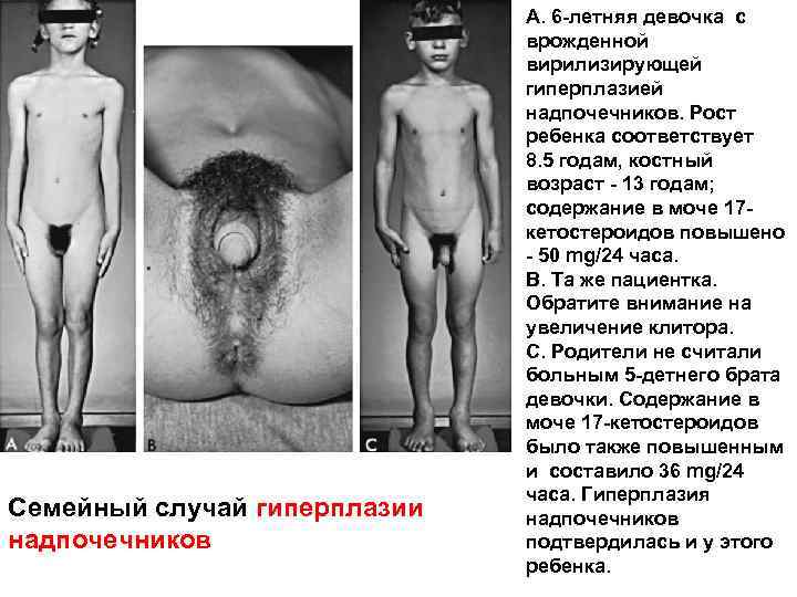 Семейный случай гиперплазии надпочечников A. 6 -летняя девочка с врожденной вирилизирующей гиперплазией надпочечников. Рост