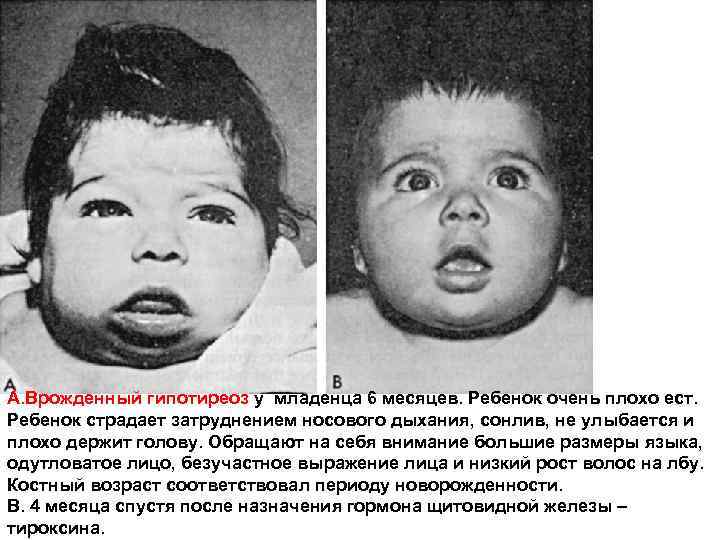 А. Врожденный гипотиреоз у младенца 6 месяцев. Ребенок очень плохо ест. Ребенок страдает затруднением