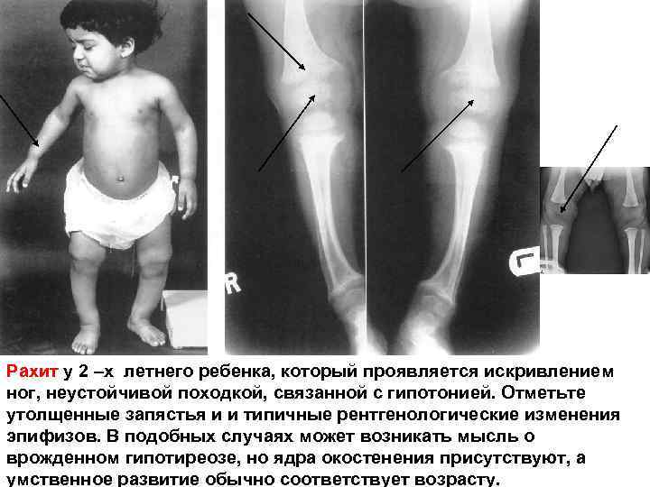 Рахит у 2 –х летнего ребенка, который проявляется искривлением ног, неустойчивой походкой, связанной с