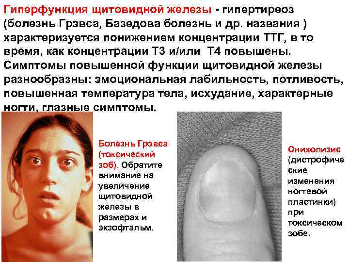 Гиперфункция щитовидной железы - гипертиреоз (болезнь Грэвса, Базедова болезнь и др. названия ) характеризуется