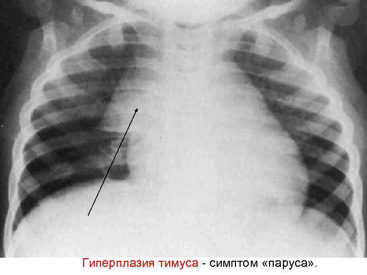 Гиперплазия тимуса - симптом «паруса» . 