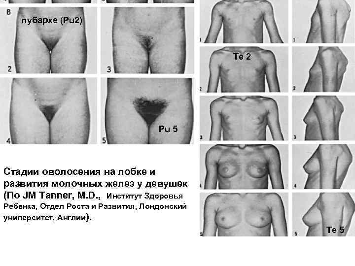 пубархе (Pu 2) Те 2 Pu 5 Стадии оволосения на лобке и развития молочных