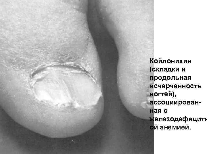 Койлонихия (складки и продольная исчерченность ногтей), ассоциированная с железодефицитн ой анемией. 