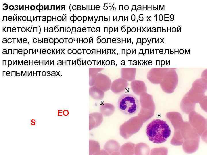 Эозинофилия (свыше 5% по данным лейкоцитарной формулы или 0, 5 х 10 Е 9