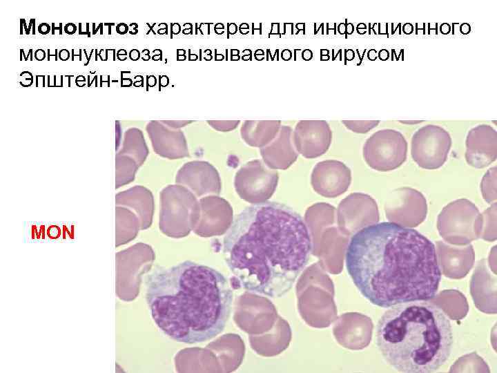 Моноцитоз характерен для инфекционного мононуклеоза, вызываемого вирусом Эпштейн-Барр. MON 