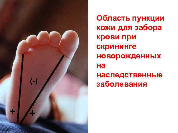  (-) + + Область пункции кожи для забора крови при скрининге новорожденных на