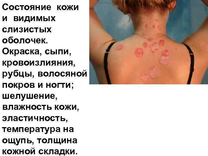 Состояние кожи и видимых слизистых оболочек. Окраска, сыпи, кровоизлияния, рубцы, волосяной покров и ногти;