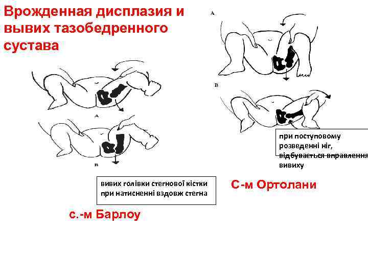 Врожденная дисплазия и вывих тазобедренного сустава при поступовому розведенні ніг, відбувається вправлення вивиху вивих