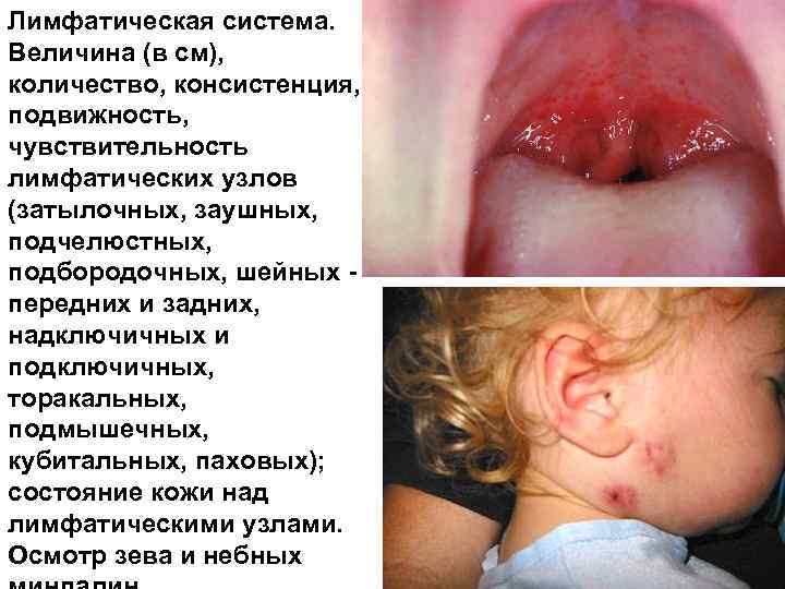 Лимфатическая система. Величина (в см), количество, консистенция, подвижность, чувствительность лимфатических узлов (затылочных, заушных, подчелюстных,