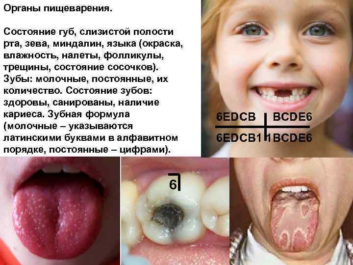 Органы пищеварения. Состояние губ, слизистой полости рта, зева, миндалин, языка (окраска, влажность, налеты, фолликулы,