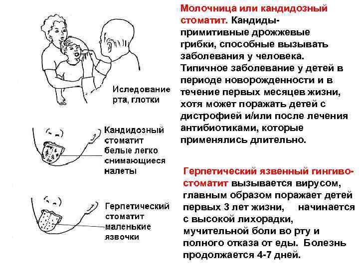 Молочница или кандидозный стоматит. Кандидыпримитивные дрожжевые грибки, способные вызывать заболевания у человека. Типичное заболевание