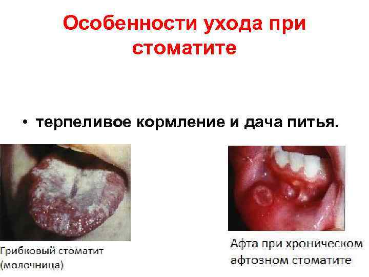 Особенности ухода при стоматите • терпеливое кормление и дача питья. 