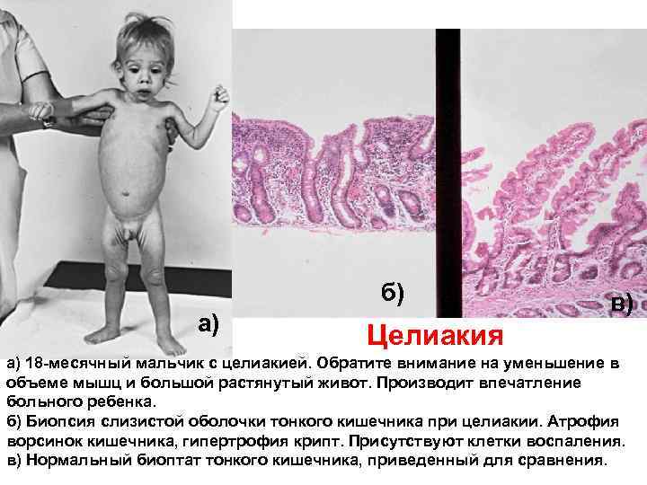 б) а) Целиакия в) а) 18 -месячный мальчик с целиакией. Обратите внимание на уменьшение