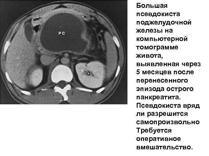 Большая псевдокиста поджелудочной железы на компьютерной томограмме живота, выявленная через 5 месяцев после перенесенного