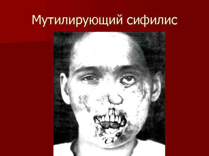 Мутилирующий сифилис 