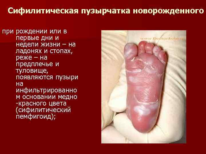 Сифилитическая пузырчатка новорожденного при рождении или в первые дни и недели жизни – на