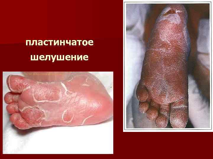 пластинчатое шелушение 