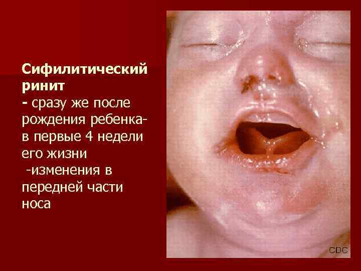 Сифилитический ринит - сразу же после рождения ребенкав первые 4 недели его жизни -изменения