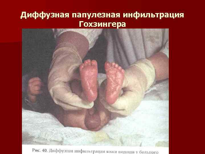 Диффузная папулезная инфильтрация Гохзингера 