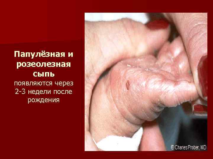 Папулёзная и розеолезная сыпь появляются через 2 -3 недели после рождения 