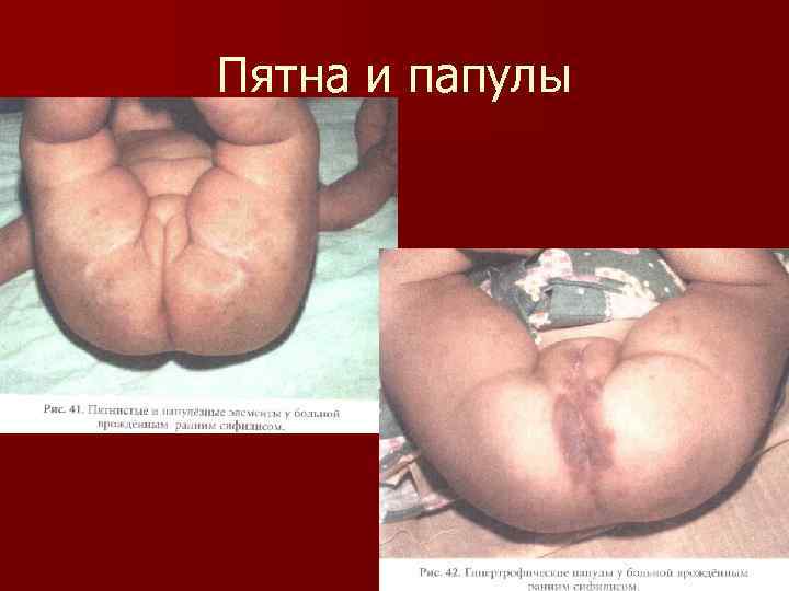 Пятна и папулы 